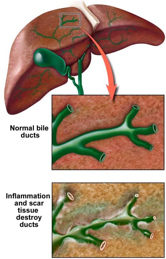 PSC Primary sclerosing cholangitis is a progressive chronic cholestatic liver disease of unknown etiology that is commonly associated with chronic colitis PSC usually