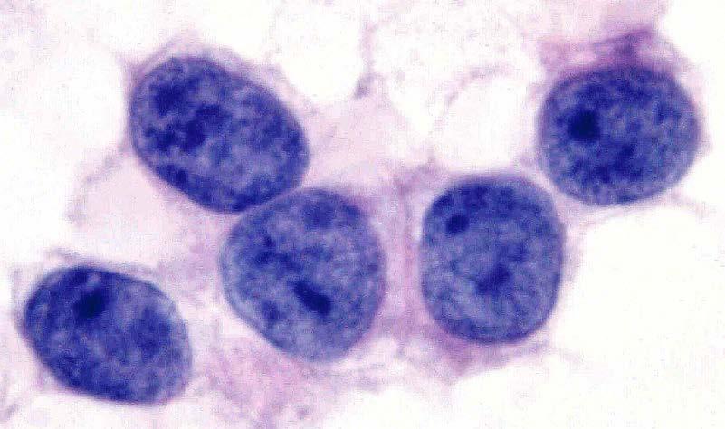 Small round & blue cell tumors Rhabdomyosarcoma Ewing sarcoma Ewing-like sarcomas Desmoplastic SRCT PD Syn S Myoepithelial tumors