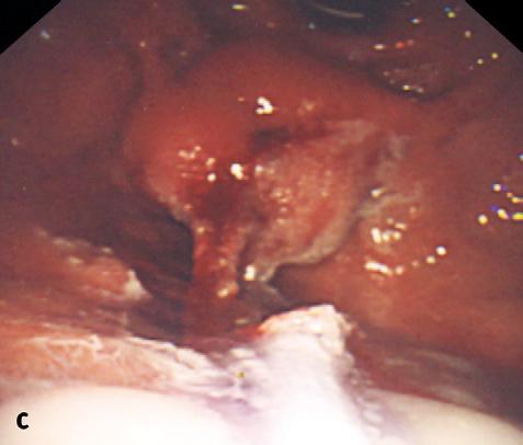 Endoscopy of the upper gastrointestinal tract should be done with adequate airway protection using endotracheal intubation if the risk of aspiration is high.