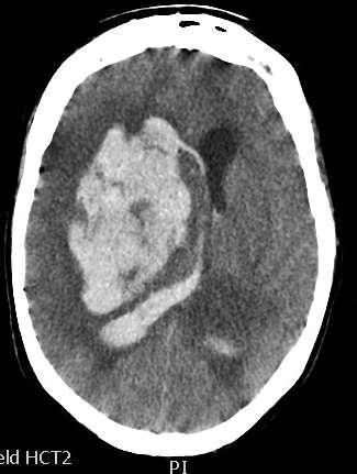 MC Case study repeat CT: large bleed with midline shift.