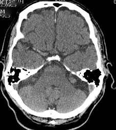 KW Case Study 30 minutes later patient was having CT head which reported : possible hyperacute R MCA infarct On the 2.