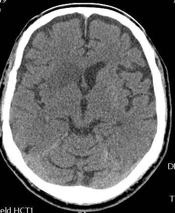 KW Case Study urgent CT results show no haemorrhage and