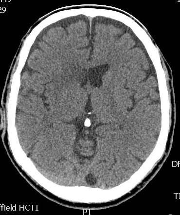 infarction of the head of the right caudate nucleus,
