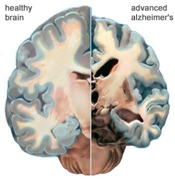 How Alzheimer s Changes the Brain