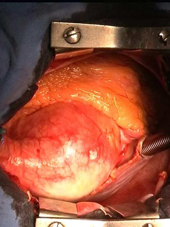 Patient Selection: Pathology Pure Aortic Regurgitation: - Aortic aneurysm - Bicuspid aortic valve -