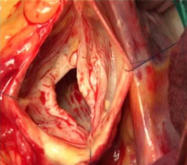 aneurysm - Bicuspid aortic valve -