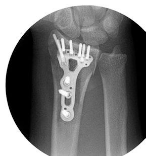 To evaluate styloid screw placement, position the wrist under fluoroscopy in an A/P view and adjust the plate so that the positioning post targets the styloid tip.