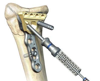 Distal Radius Fractures Distal Screw Options: There are four options of 2.