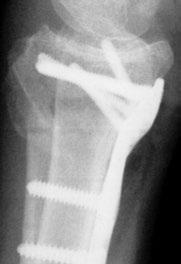 screws. Note: It is recommended that the entire distal row and the two radial styloid holes be filled with screws.