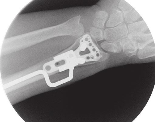 plates, allowing the surgeon to verify screw placement.