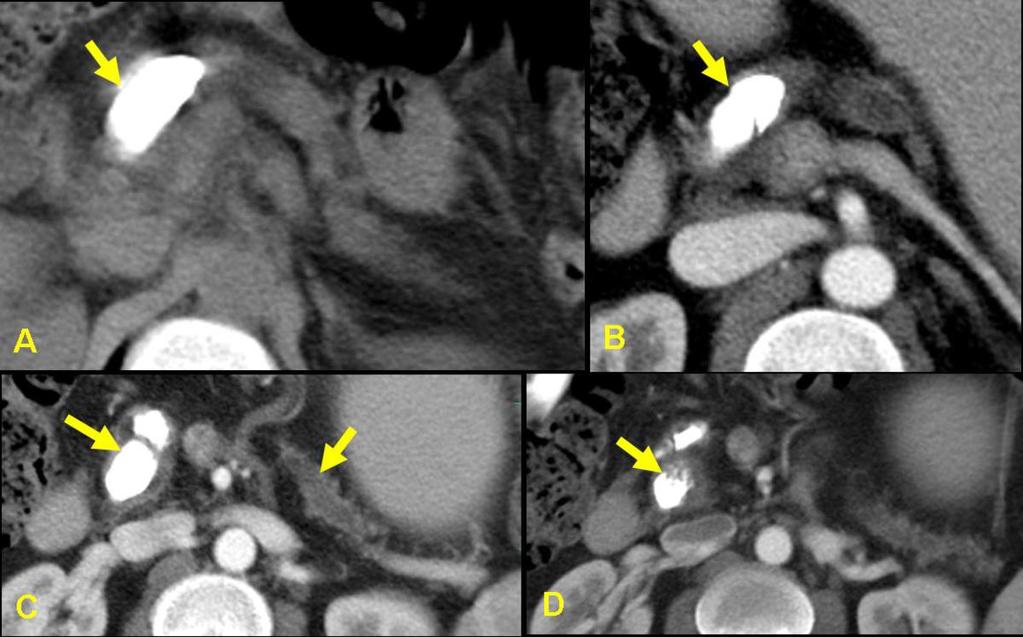 Large calculi distributed predominantly in the the head region of pancreas. Fig. 8: A 25-year male patient with TCP.