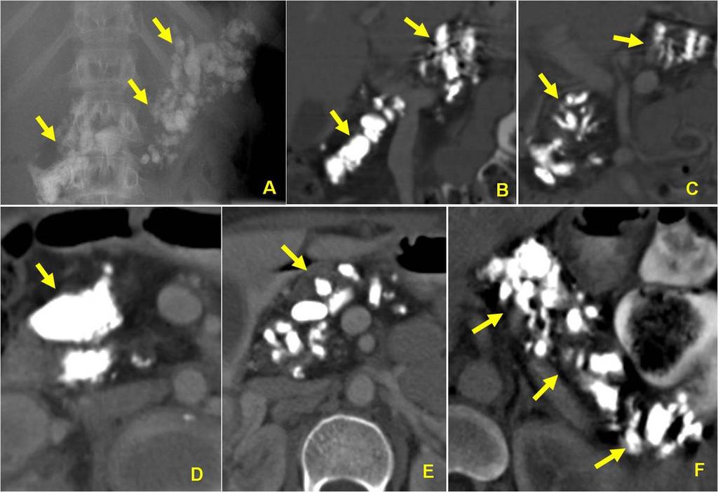 Fig. 10: A 20-year male patient with TCP. Axial images of Computed tomography (CT) shows artophic pancreas and uniform sized calculi distributed throughout the pancreas [arrow].