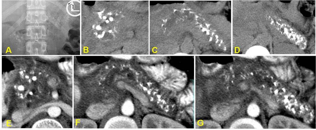 Fig. 11: A 30-year male patient with TCP presented with acute pain abdomen. Axial images of Computed tomography (CT) shows features of acute pancreatitis in background of TCP.