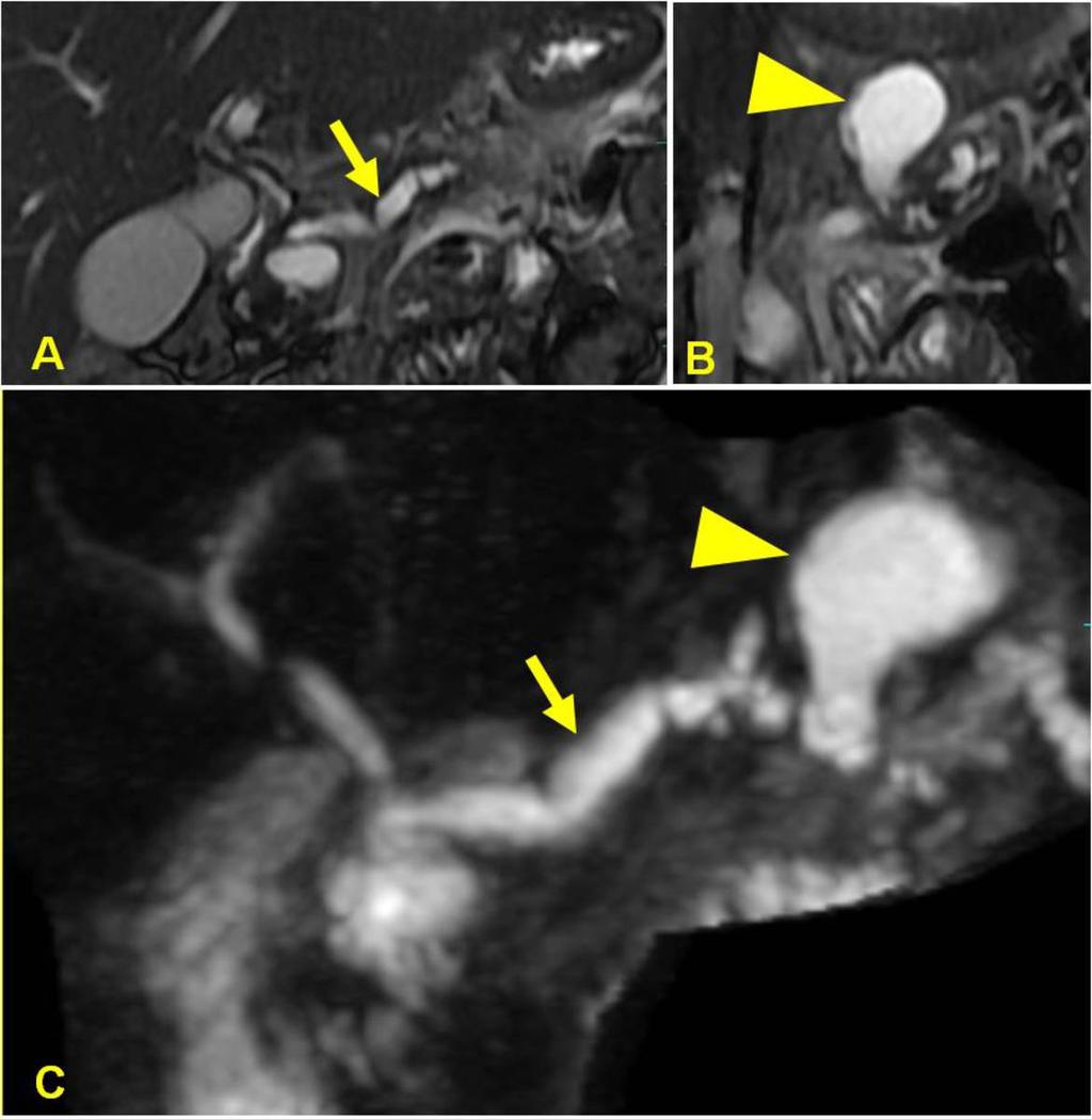 Fig. 12: A 32-year male patient with TCP with recurrent episode of acute pancreatitis.