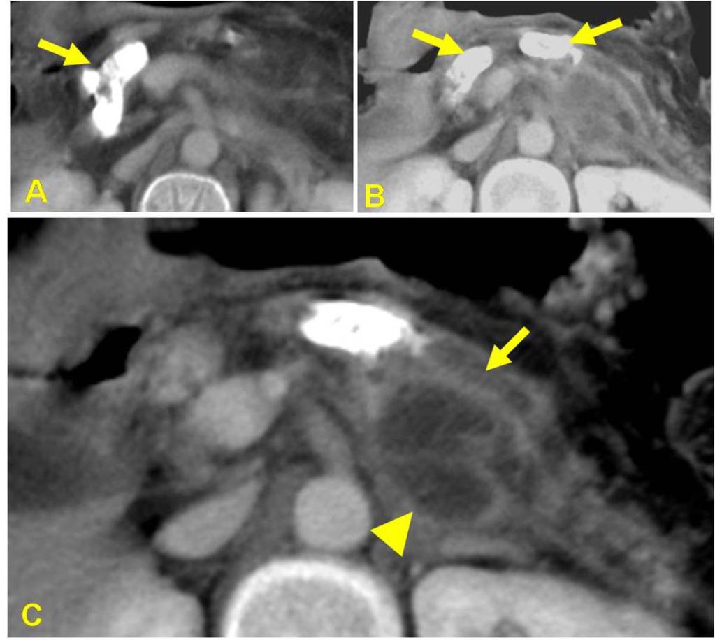 Fig. 13: A 35-year male patient with TCP with recurrent episode of acute pancreatitis.