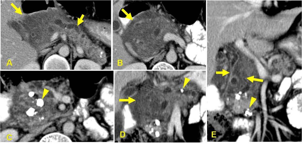 Fig. 15: A 40-year male patient with TCP with recurrent episode of acute pancreatitis. CT images shows, irregular dilated main pancreatic duct [A, arrow] and calcifications in head region [C,arrow].