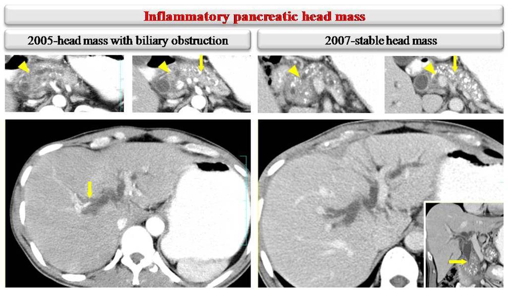 Fig. 16: A 40-year male patient with TCP with obstructive jaundice. pancreatitis. Initial CT images shows features of TCP with pancreatic head mass causing distal CBD obstruction and mild IHBRD.