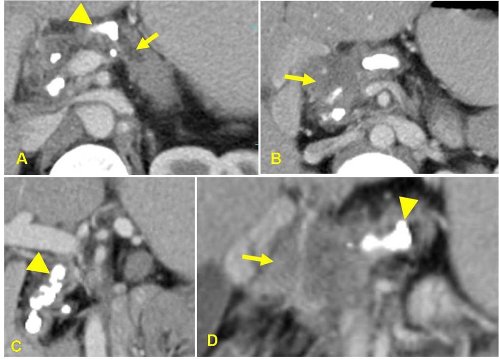 Fig. 17: A 42-year male patient with TCP. CT images shows hypodense mass in pancreatic head region with encasement and narrowing of hepatic artery [B,D].