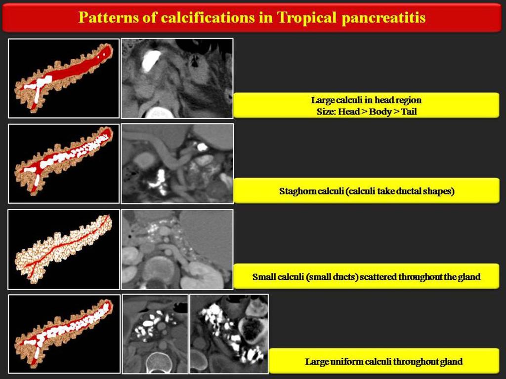 Fig. 5: Patterns of calcifications in Tropical Chronic pancreatitis References: Dr.Chinmay Kulkarni Numerous tiny calculi diffusely scatterd throughout the gland.