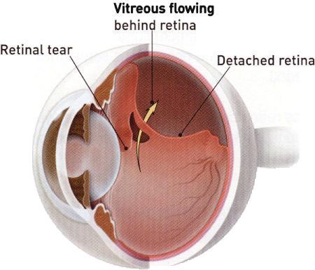 When retinal detachment is present, the fluid is called subretinal fluid and is in the sub-retinal space. What causes retinal detachment? There are three major types of retinal detachments.