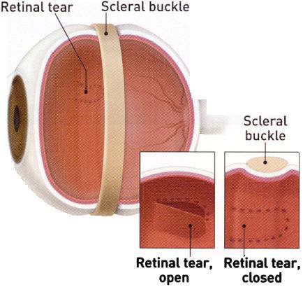 The surface tension of the gas holds the retina in place while the laserpexy or cryopexy placed around the retinal tears during the surgery creates a permanent seal of the retinal tears.