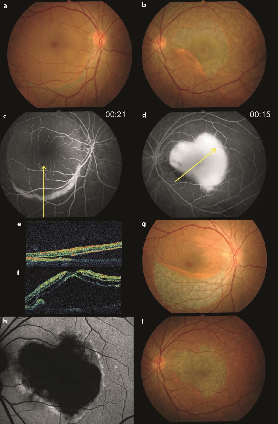 354 Fig. 2. Case 2. a, b Fundus photography illustrates serous RPE detachment and RPE tear in both eyes.