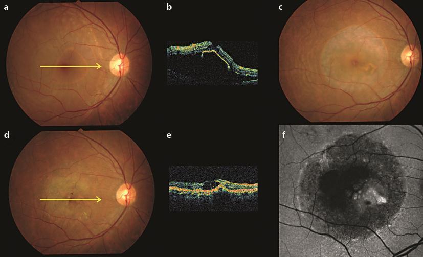 355 Fig. 3. Case 3. a Fundus photography of the right eye shows a 360 RPE tear. b OCT demonstrates retracted RPE tissue.