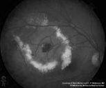 Coats Disease Coats Disease # AKA Exudative Retinitis # Progressive condition of retinal capillaries which occurs in children and young adults, usually males # Typically presents in first decade of