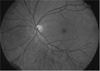 To Find Small Ocular Symptoms: " Most are asymptomatic " Blurred vision "Scotoma or loss of visual field "Photopsia