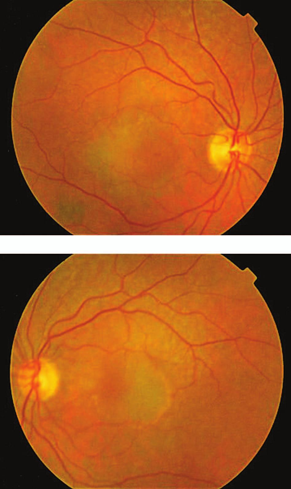 Challenging Case Bilateral Elevated Macular Lesions Section Editor: Alireza Ramezani, MD Case presentation A 65-year-old woman presented with decreased vision in both eyes of 2 months duration.