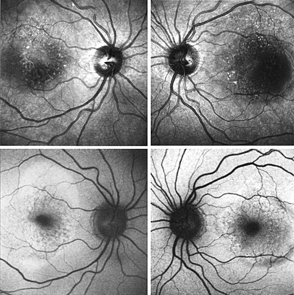 On fundus examination, an elevated lesion was noted in the macula in both eyes. Figures show color fundus (Fig. 1), infrared, and autofluorescence (AF) images (Fig.