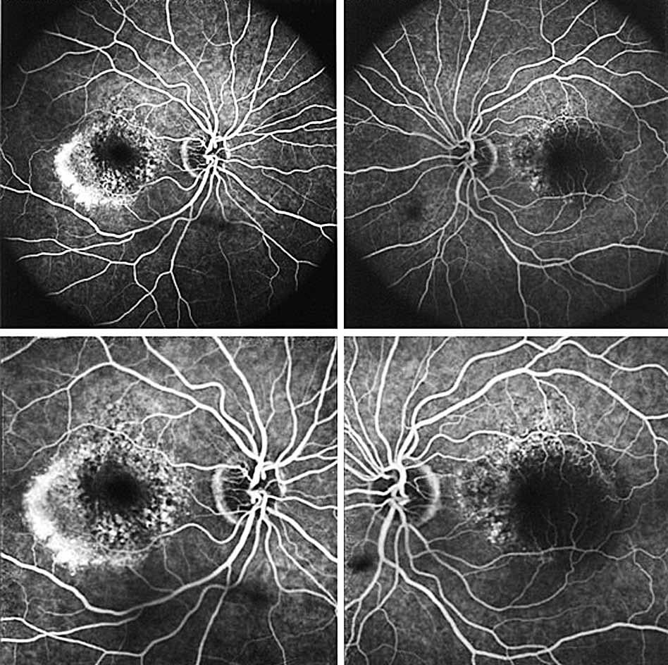 One issue is whether to treat both eyes in the same session or on separate days. Concerns for endophthalmitis deter me from treating both eyes on the same day.