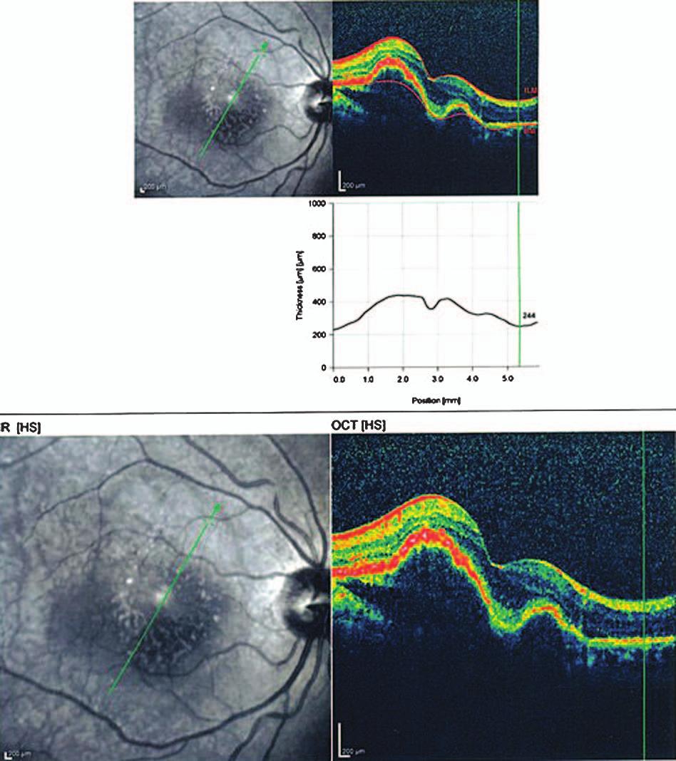 Fundus AF displays faint hyper-autofluorescence of the lesion with areas of hypoautofluorescence (Fig. 2) within it.