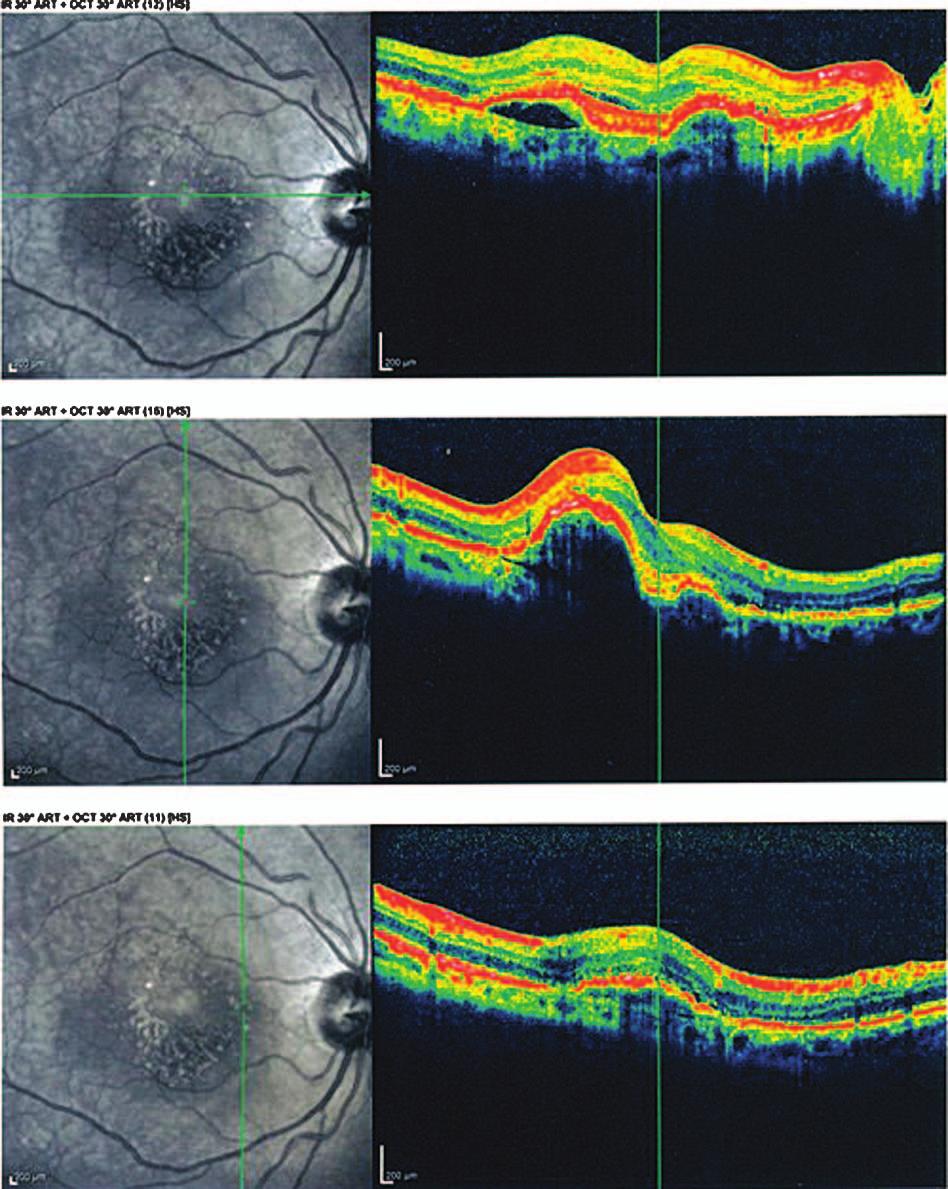 There is vascularized RPED in both eyes on OCT images (Figures 6 and 7). According to these findings, the most probable diagnosis is occult choroidal CNVM type I, a form of wet AMD.