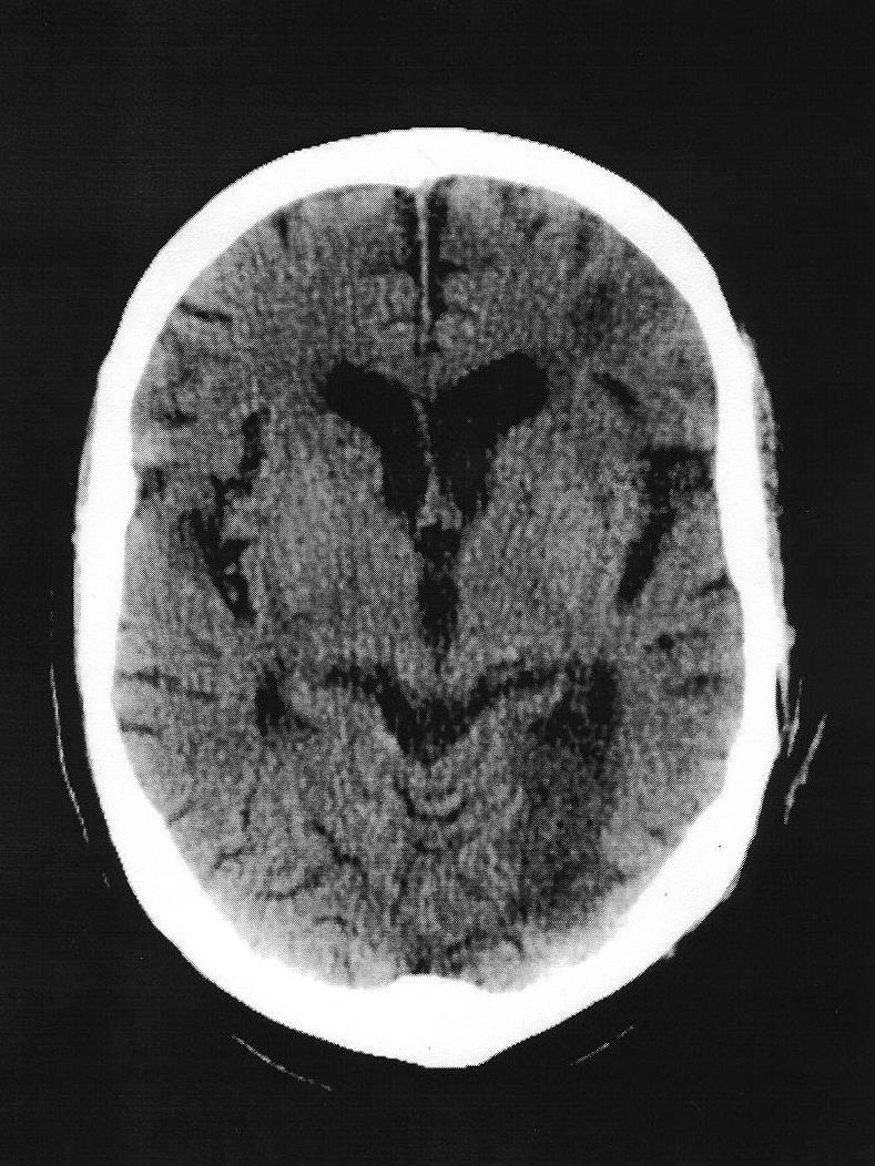 Case: post-stroke major depression 77 year old married man had his first hospitalization for major depression with psychosis several months after a stroke.