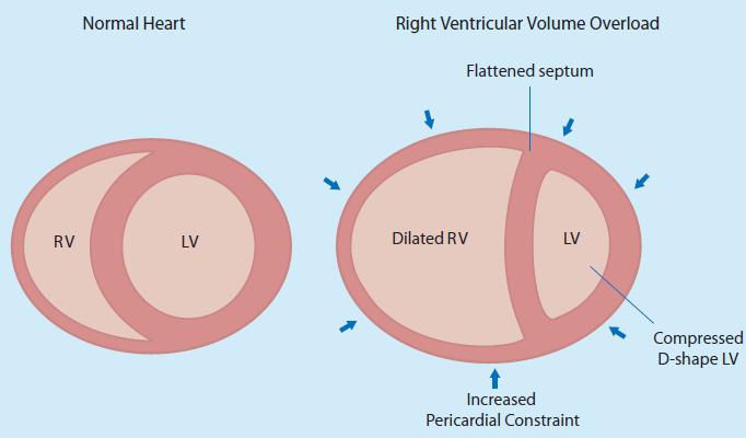 RV and LV are interlinked: by a shared wall (the septum) by mutually encircling epicardial fibers by attachment of the RV free wall to the
