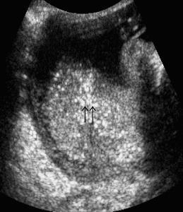 inflammation Focal necrosis Hemorrhage Hepatic calcification