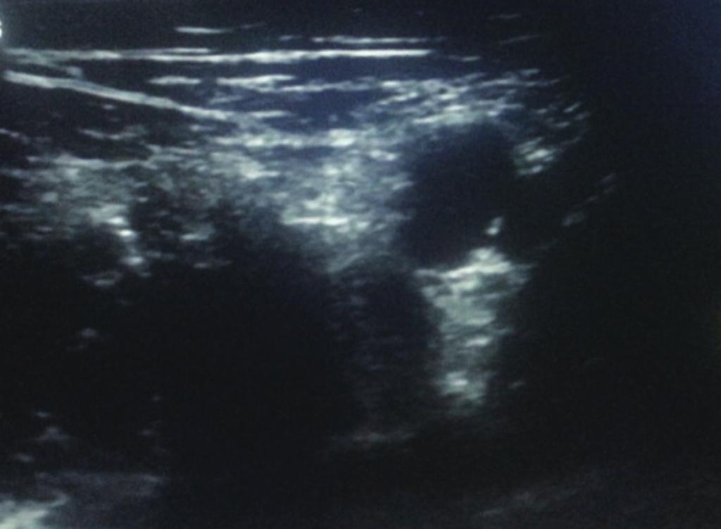 Hee Kyung Lee et al. n a m A B Fig. 1. Ultrasound-guided three-in-one block method.