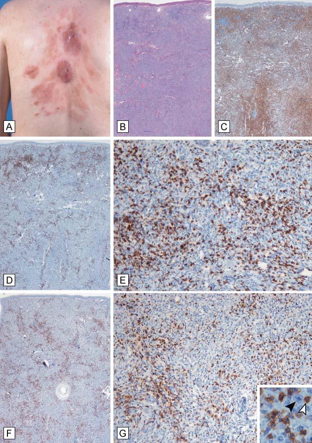 Figure 3. Representative histopathologic features of a primary cutaneous follicle center lymphoma (PCFCL) patient with a diffuse growth pattern.