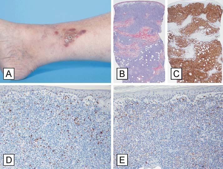 Figure 5. Histopathologic features of a primary cutaneous diffuse large B-cell lymphoma leg type (PCLBCL LT) patient. (A) Patient presenting with tumors on the medial side of the right ankle.
