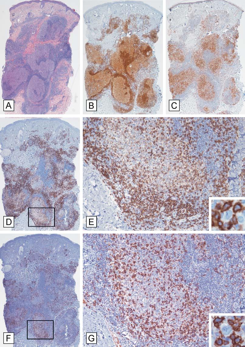 Figure 2. Representative histopathologic features of a primary cutaneous follicle center lymphoma (PCFCL) patient with a mainly follicular growth pattern.
