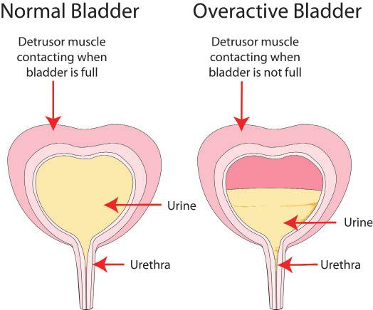 Overactive bladder Information for patients from Urogynaecology An overactive bladder (OAB) is a very common problem. It can cause distressing symptoms that are difficult to control.