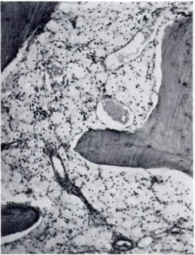 xanthomatous cells. (x 80.