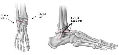 Sprained Ankle An ankle sprain occurs when the strong ligaments that support the ankle stretch beyond their limits and tear. Ankle sprains are common injuries that occur among people of all ages.