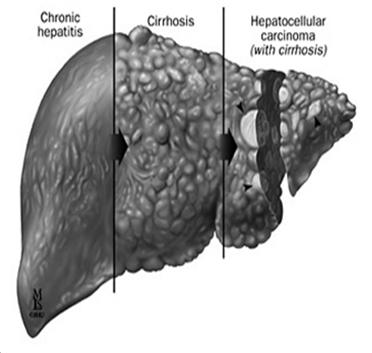 Fibrosis The accumulation of tough, fibrous scar tissue in the liver. As the inflammation and liver injury continue, scar tissue builds up and connects with existing scar tissue.