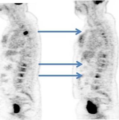 [1 8 F) FDG PET/CT ( Response ( No Response Fused [1 8 F) FDG PET/CT After 2 lnjections of Ra-223 Response