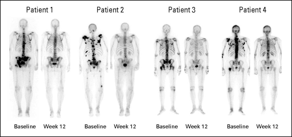 Bone scan effects of cabozantinib treatment on study patients.