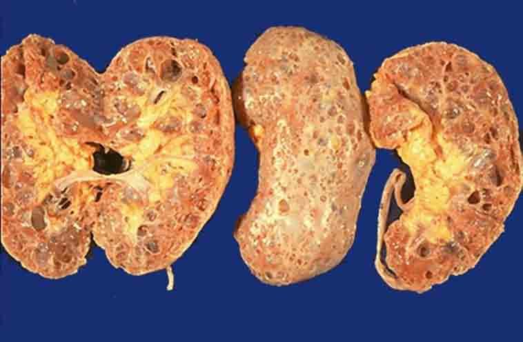 Acquired Renal