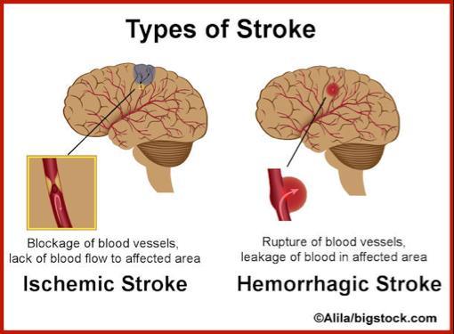 5.7 Cardiovascular Disorders Stroke Stroke aka