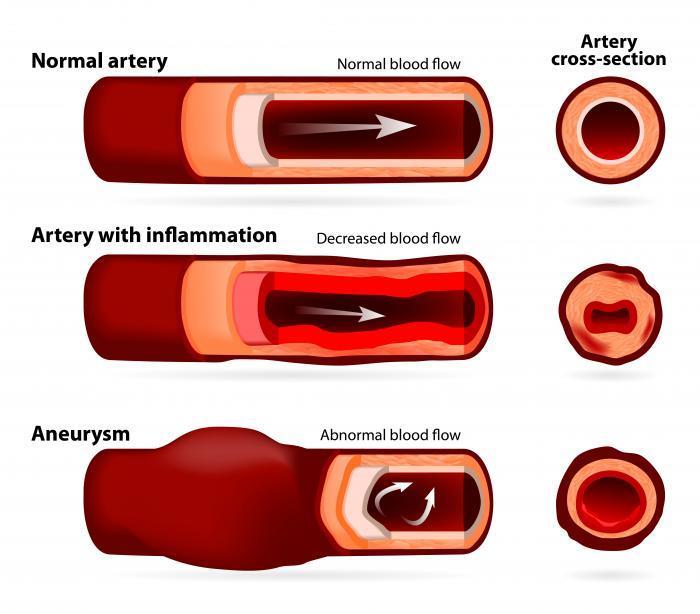 5.7 Cardiovascular Disorders Aneurysm Blood